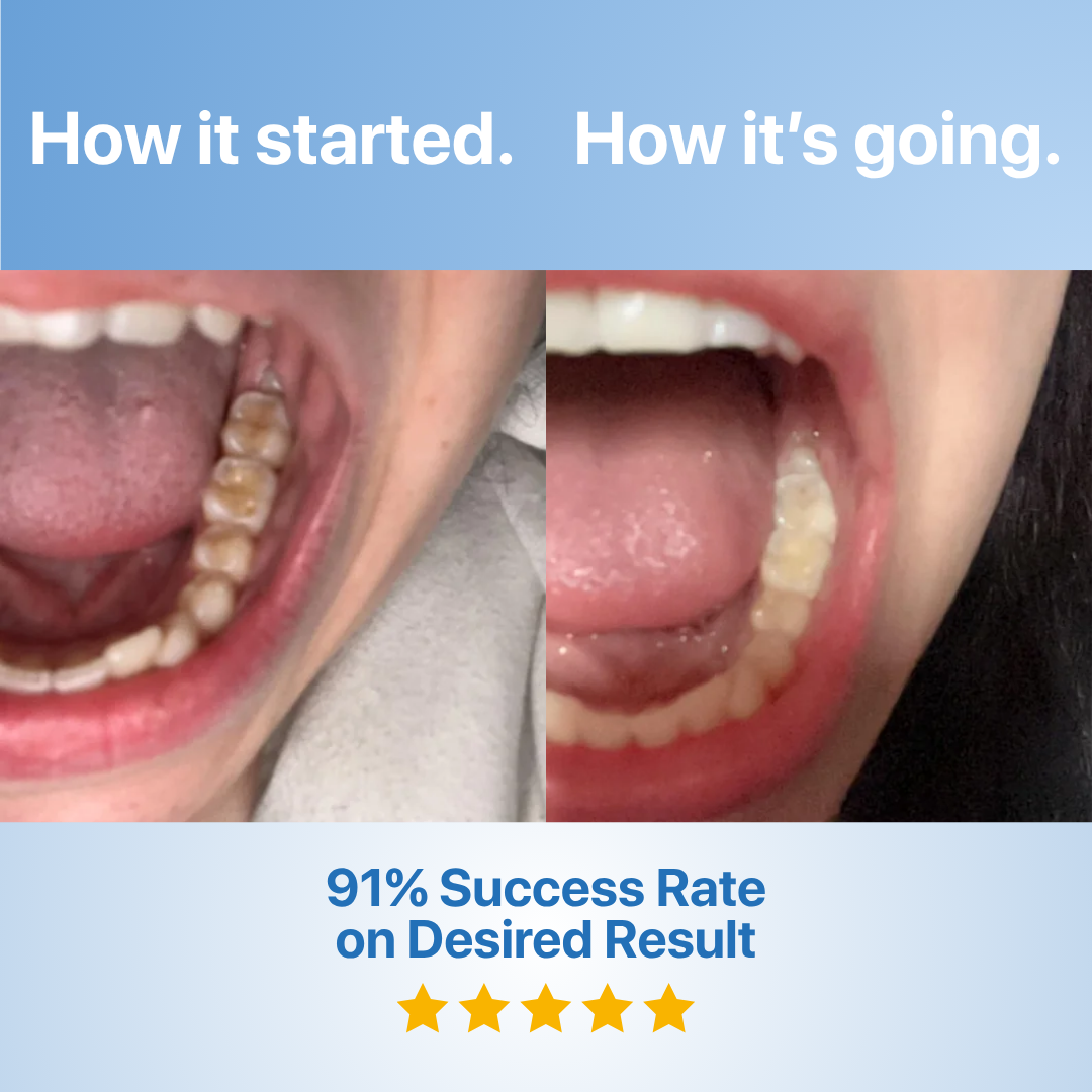 🔥Last Day 49% OFF🔥Dental Tooth Armor